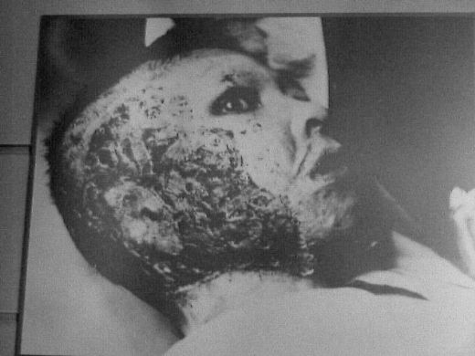 Radyasyon Yanıkları Belirtileri ve Tedavisi